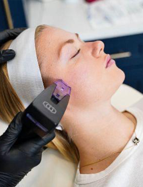 Sivilce İzi Tedavisi - Morpheus 8 Altıniğne Uygulaması