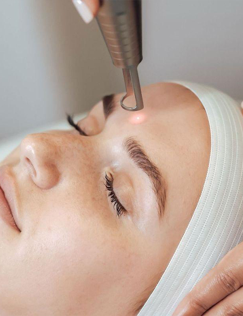 Tüy Sarartma - Switched Lazer